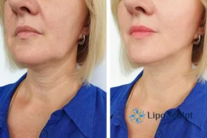 Double chin before and after Hi-Fu treatment 4 Book your double chin treatment Great Baddow today! We are here to help!