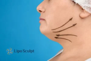 Double chin before and after Hi-Fu treatment 3 Boost your confidence with a Double chin treatment Great Baddow