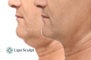 Double chin before and after Hi-Fu treatment 2 Double chin treatment Great Baddow from Lipo Sculpt - feel more confident today!