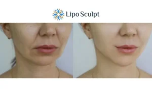 Explaining Total Skin Tightening Treatment And What It Can Do For You 2 Do you want to boost your self confidence? Give Morpheus8 Great Baddow a try today!