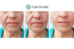 Explaining Total Skin Tightening Treatment And What It Can Do For You 3 Boost your confidence with Morpheus8 Great Baddow call our team today!