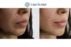Explaining Total Skin Tightening Treatment And What It Can Do For You 4 Morpheus8 Great Baddow the best results - call our team today!