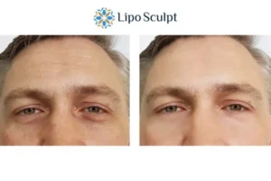 Explaining Total Skin Tightening Treatment And What It Can Do For You 6 Morpheus8 Great Baddow book in today to find out more!