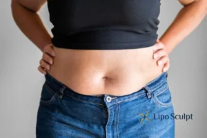 Bidding Farewell to Muffin Tops with Aqualyx Fat Injections 2 Do you wish you could reduce your muffin top Great Baddow With Aqualy fat dissolving injections you can!