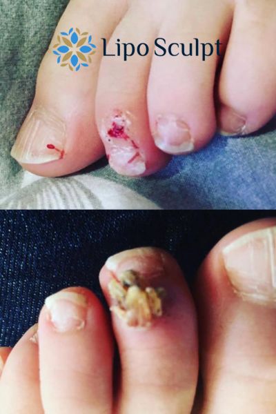 Wart removal customer results from Lipo Sculpt Great Baddow